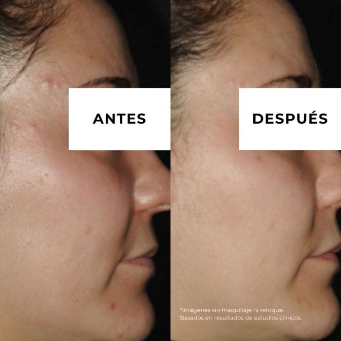 Equilibrium Crema Antiacne