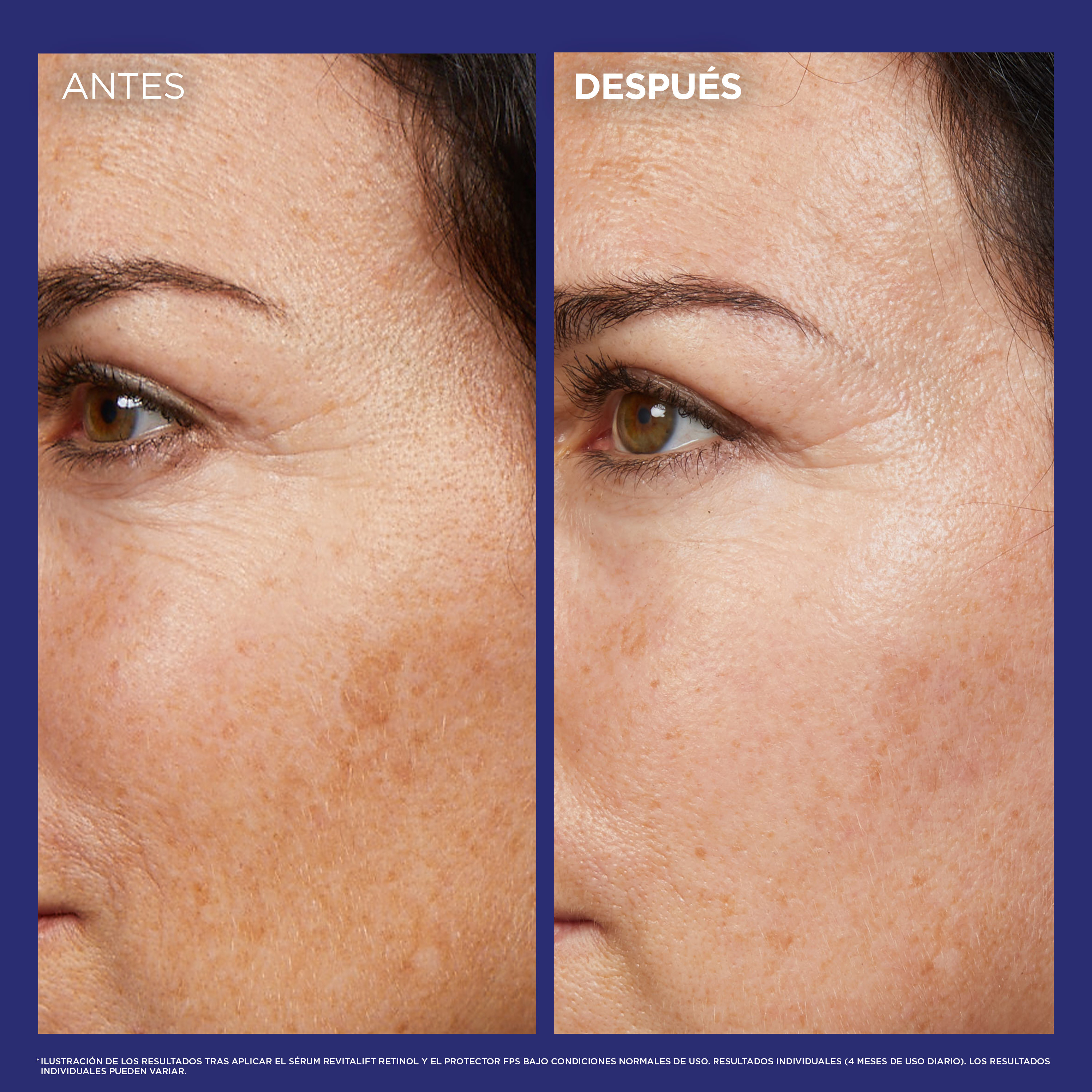 Revitalift Laser serum de noche retinol puro arrugas profundas · detalle 5
