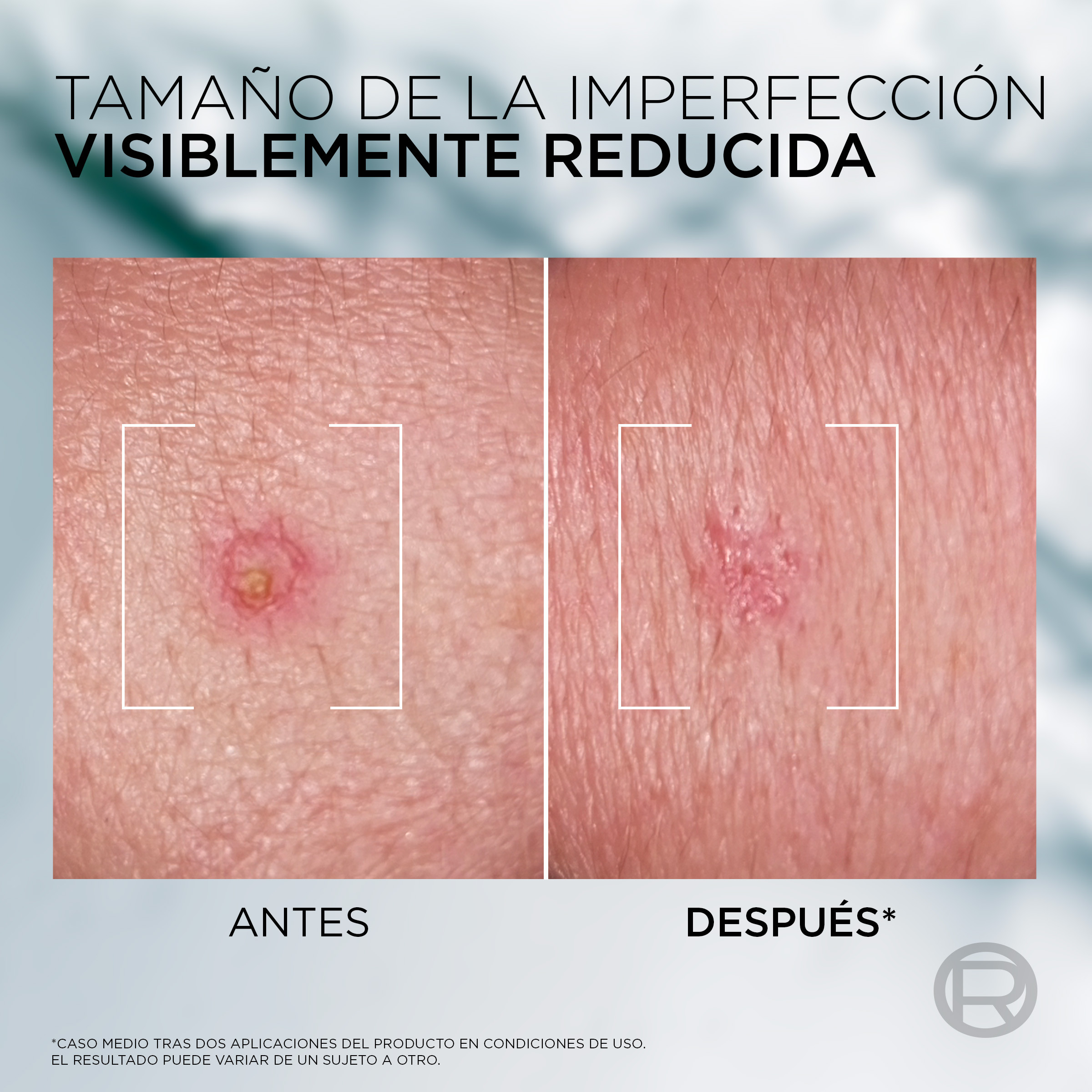 Men Expert Derma Control S.O.S Pimple Paste Solución Anti-imperfecciones con Niacinamida y Ácido Glicólico · detalle 2