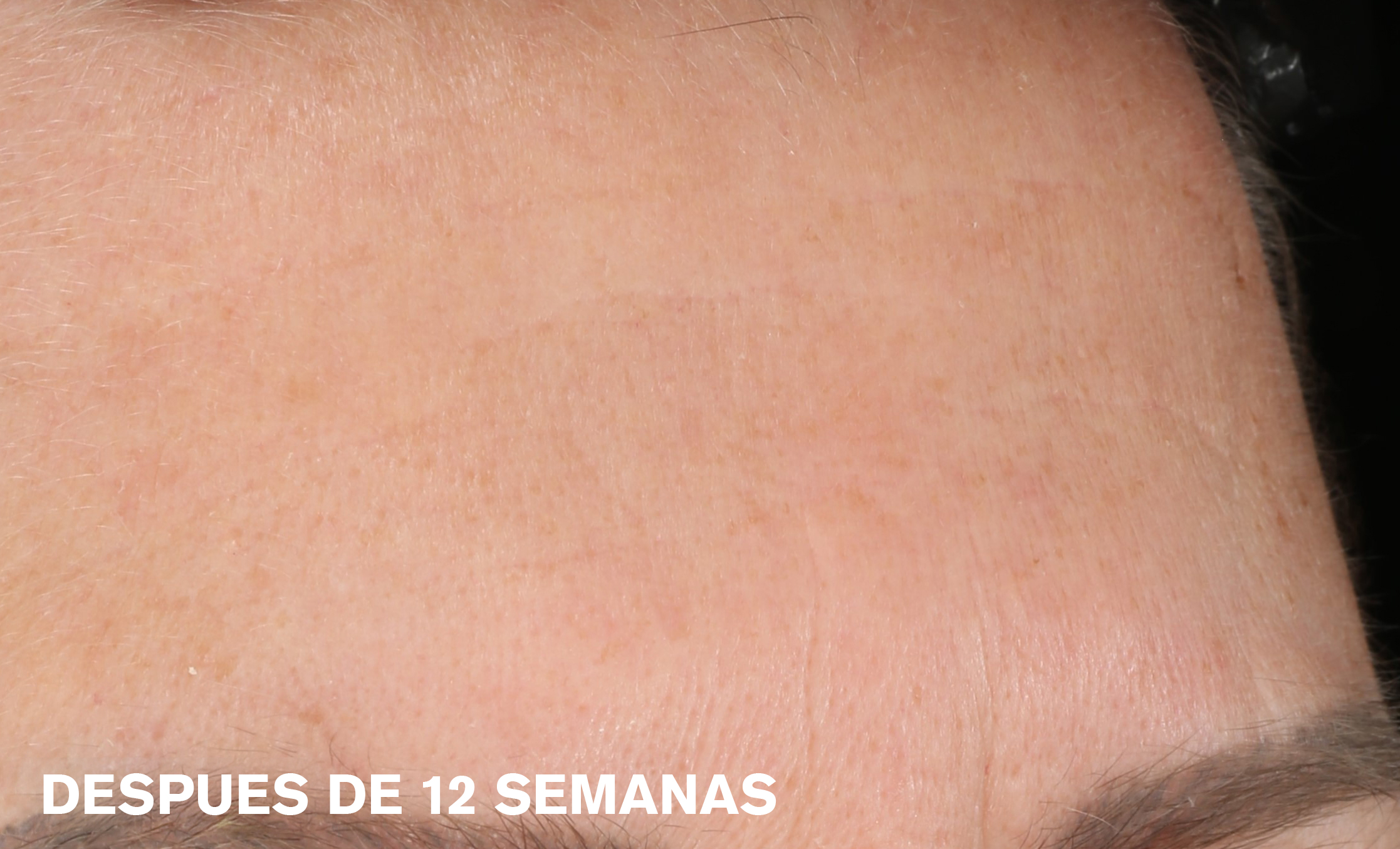 Estée Lauder Facial Serum Después 1
