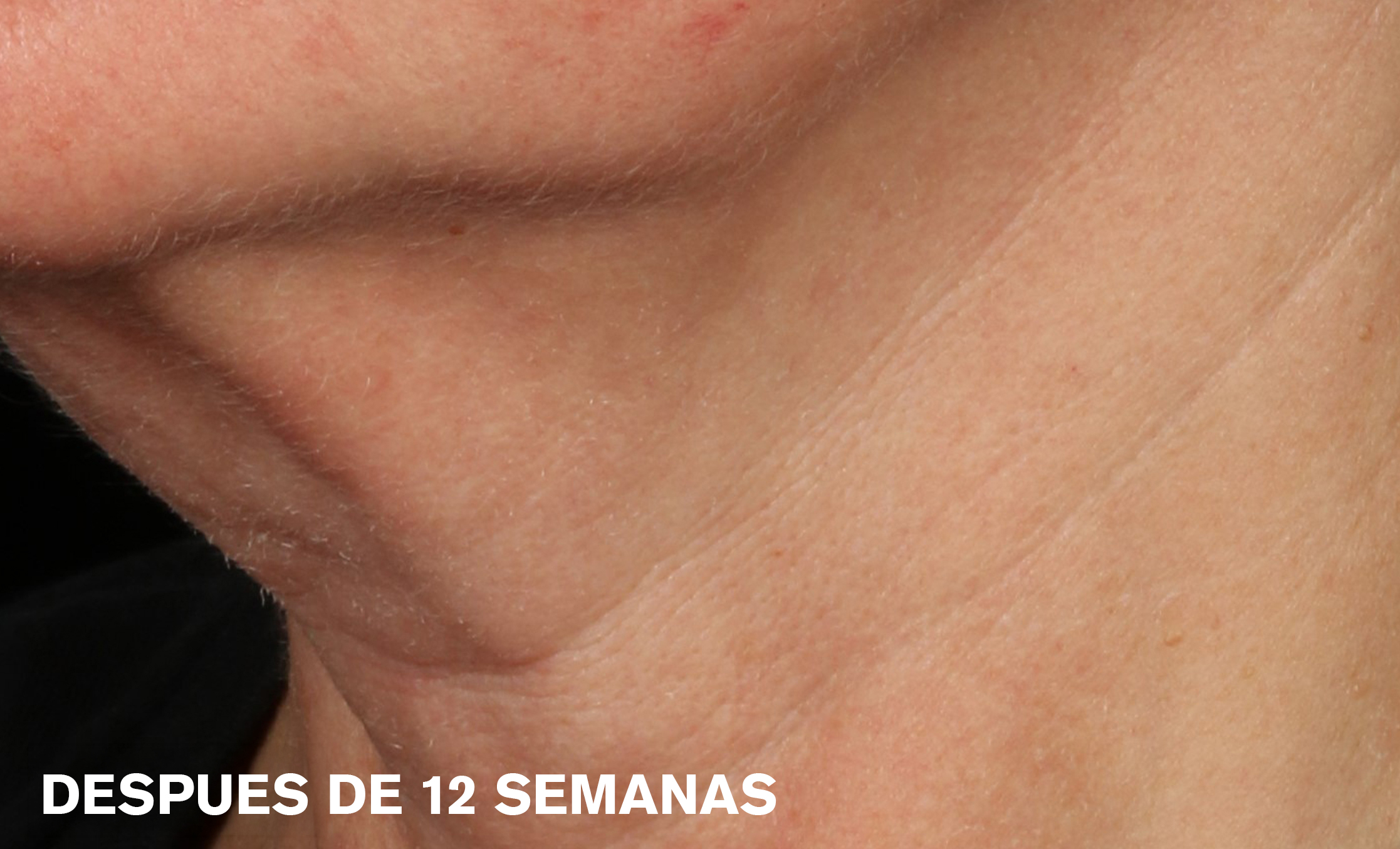 Estée Lauder Facial Serum Después 2